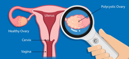 ovarian cancer